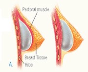 Breast AumentationPlacement