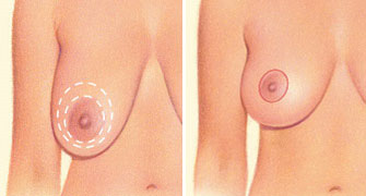 Saline Implant