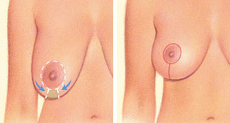 Saline Implant