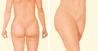 Liposuction Area2