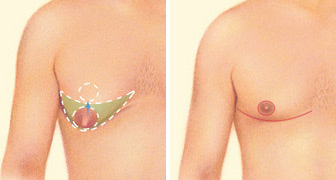 Saline Implant