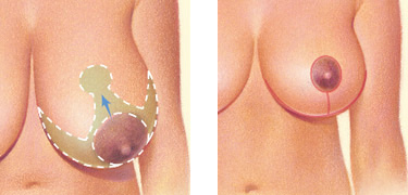 Saline Implant