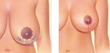 Saline Implant