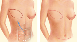 Saline Implant